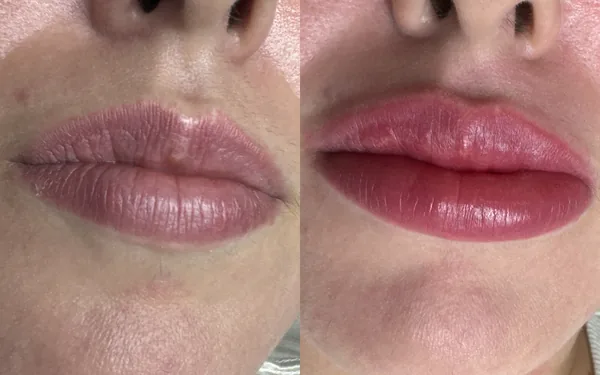 Antes e depois de micropigmentação labial: lábios sem cor à esquerda e, à direita, logo após a sessão