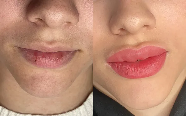 Antes e depois de micropigmentação labial: lábios pálidos à esquerda e lábios rosados e definidos à direita